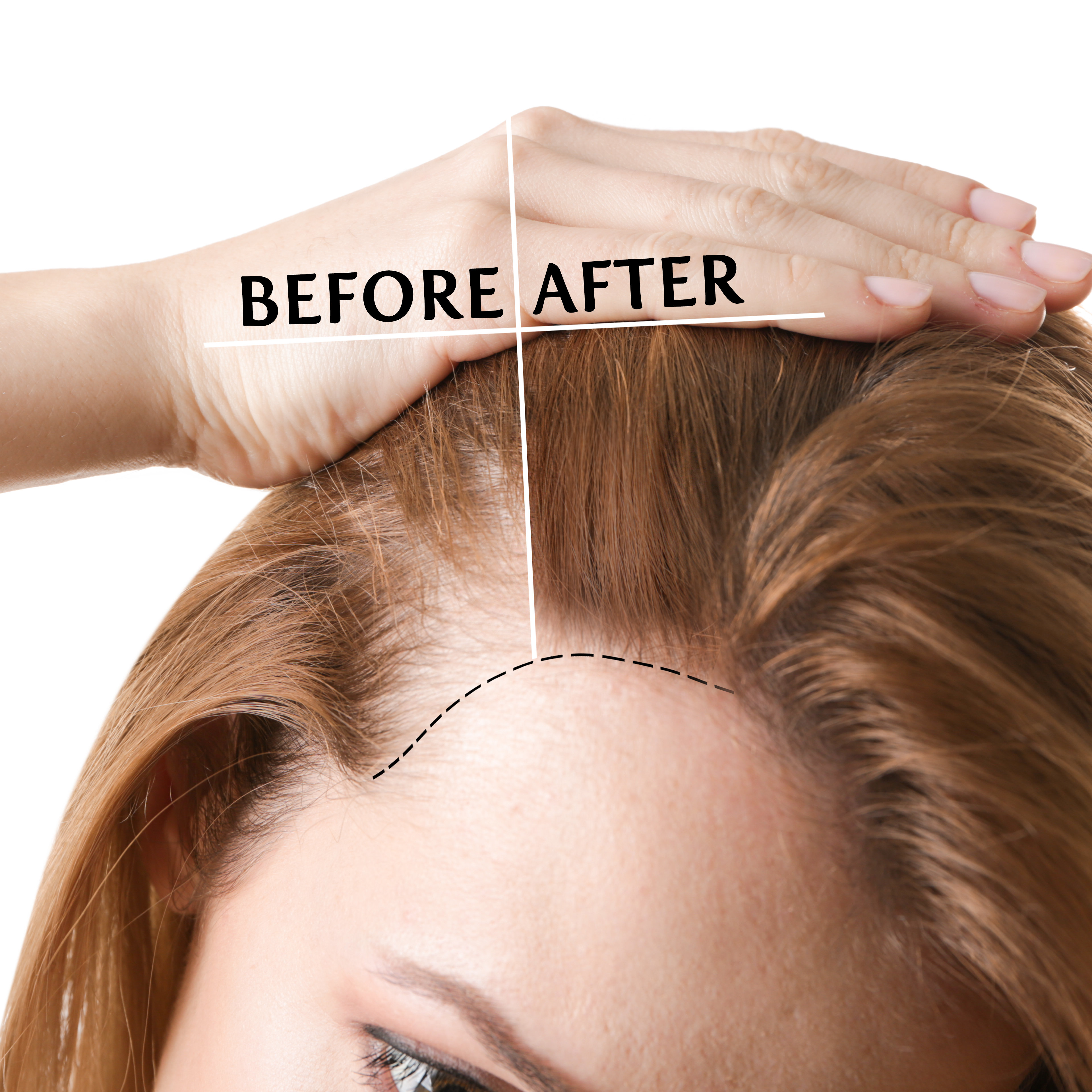Woman,Before,And,After,Hair,Loss,Treatment,On,White,Background